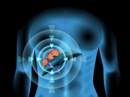 gran paso tratamiento carcinoma hepatocelular
