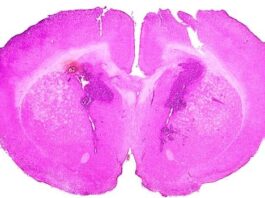 terapia glioma Adastra Pharma resultados positivos en la fase Ib