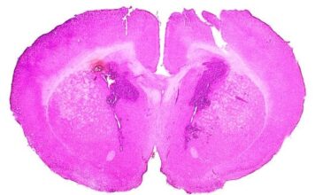 terapia glioma Adastra Pharma resultados positivos en la fase Ib
