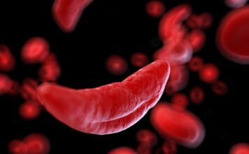 El objetivo de células falciformes podría tratar el COVID