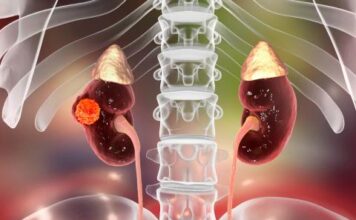 La National Comprehensive Cancer Network crea pautas para tratamiento tumor de Wilms