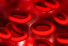 Los ensayos de terapia génica de células falciformes se detienen después de que los pacientes desarrollan SMD, LMA