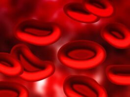 Los ensayos de terapia génica de células falciformes se detienen después de que los pacientes desarrollan SMD, LMA