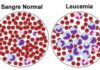 Leucoblastos: qué son y cómo se relacionan con otras células en la leucemia