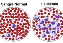 Leucoblastos: qué son y cómo se relacionan con otras células en la leucemia