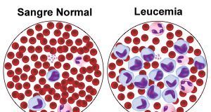 Leucoblastos: qué son y cómo se relacionan con otras células en la leucemia
