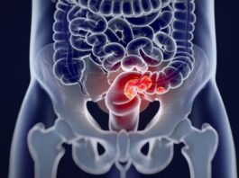 Investigación de Fisabio analiza la relación entre bacterias intestinales y cáncer de colon en pacientes con síndrome de Lynch