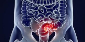 Investigación de Fisabio analiza la relación entre bacterias intestinales y cáncer de colon en pacientes con síndrome de Lynch