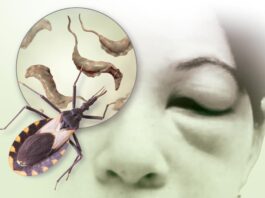 El chagas afecta más a los más marginados