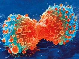 Células inmunitarias promotoras de tumores capacitadas para combatir el tipo de cáncer cerebral más agresivo