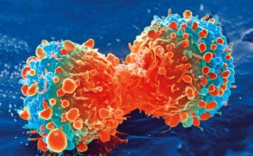 Células inmunitarias promotoras de tumores capacitadas para combatir el tipo de cáncer cerebral más agresivo