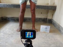 Imágenes térmicas infrarrojas como una nueva herramienta no invasiva en el punto de atención para evaluar la filariasis linfática