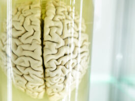 La atrofia del córtex cerebral se relaciona con apatía en pacientes de Huntington