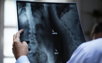 AAV8-TNAP-D10 podría ser un tratamiento eficaz para la hipofosfatasia