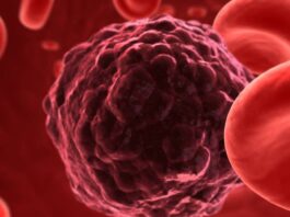 La terapia con células T con CAR es una nueva opción para pacientes con mieloma múltiple