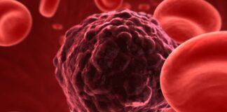 La terapia con células T con CAR es una nueva opción para pacientes con mieloma múltiple