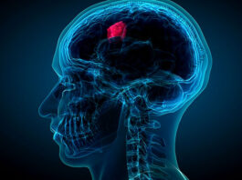 Las estructuras linfoides terciarias pueden ayudar a combatir los gliomas