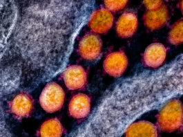 Un perfil de expresión de 50 genes en sangre para identificar qué pacientes de COVID-19 evolucionarán peor