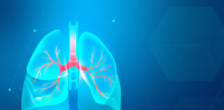 Desentrañando los misterios de una rara enfermedad, la linfangioleiomiomatosis