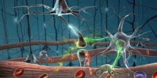 Neuroimagen para detectar eficacia de terapia génica temprana en enfermedad de Huntington
