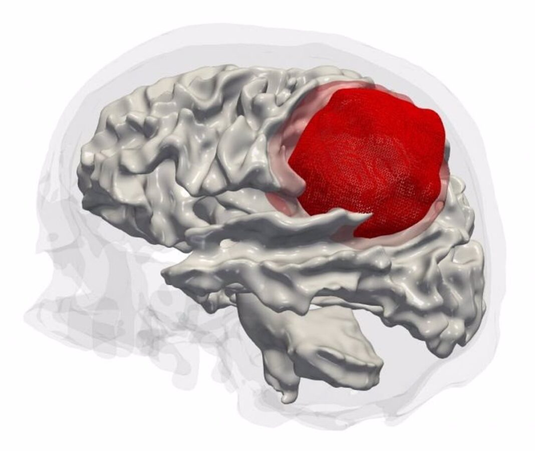 Los virus oncolíticos pueden ser útiles en el tratamiento del glioblastoma