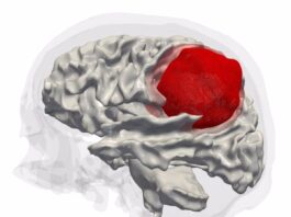 Los virus oncolíticos pueden ser útiles en el tratamiento del glioblastoma