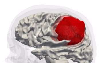 Los virus oncolíticos pueden ser útiles en el tratamiento del glioblastoma